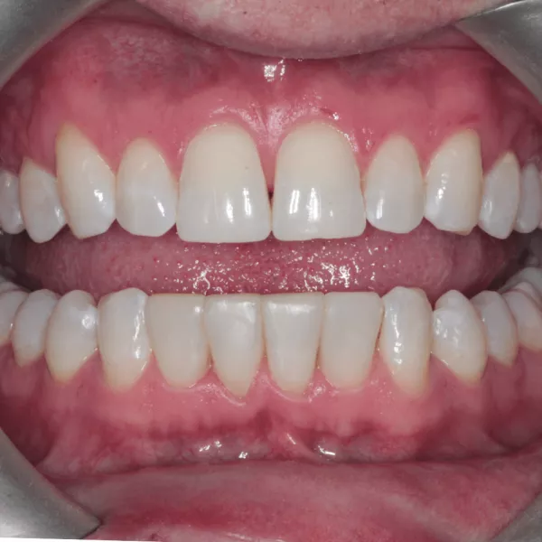 After Invisalign and 4 bondings