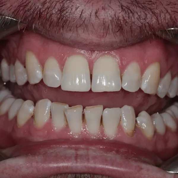 Before Invisalign and 4 bondings