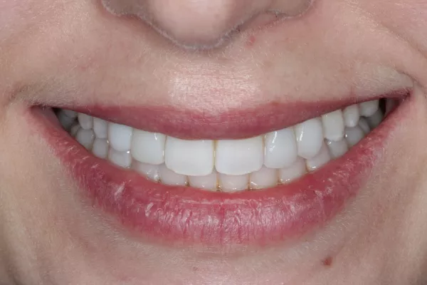 After Invisalign, Whitening and 4 bondings