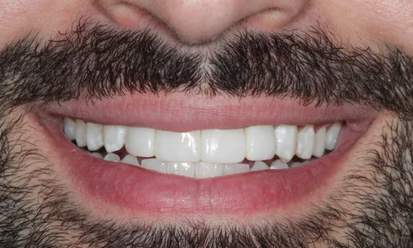 After Invisalign, Whitening and 4 Bondings
