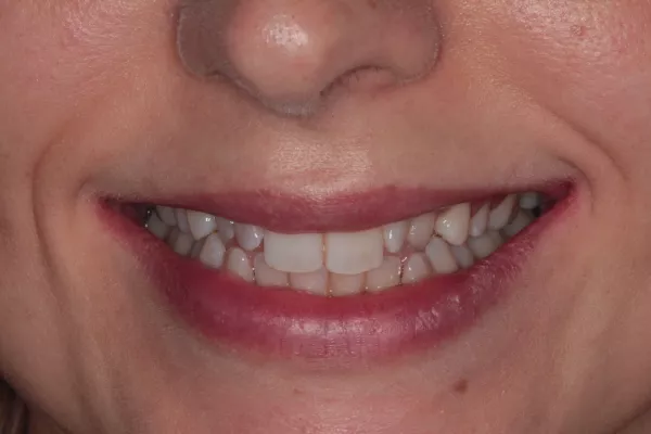 Before Invisalign, Whitening and 4 bondings