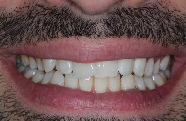 Before Invisalign, Whitening and 4 Bondings