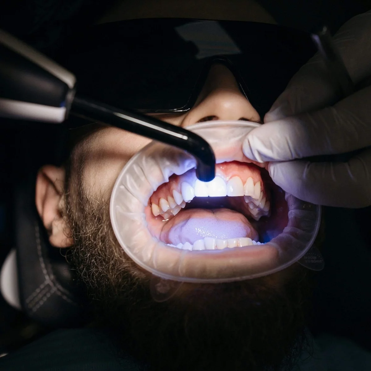 Composite bonding at Harmoni Dental - Norbiton, Kingston-upon-Thames