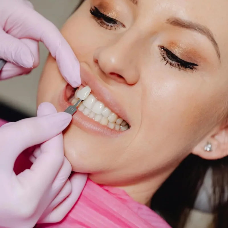 What happens at your composite bonding consultation?