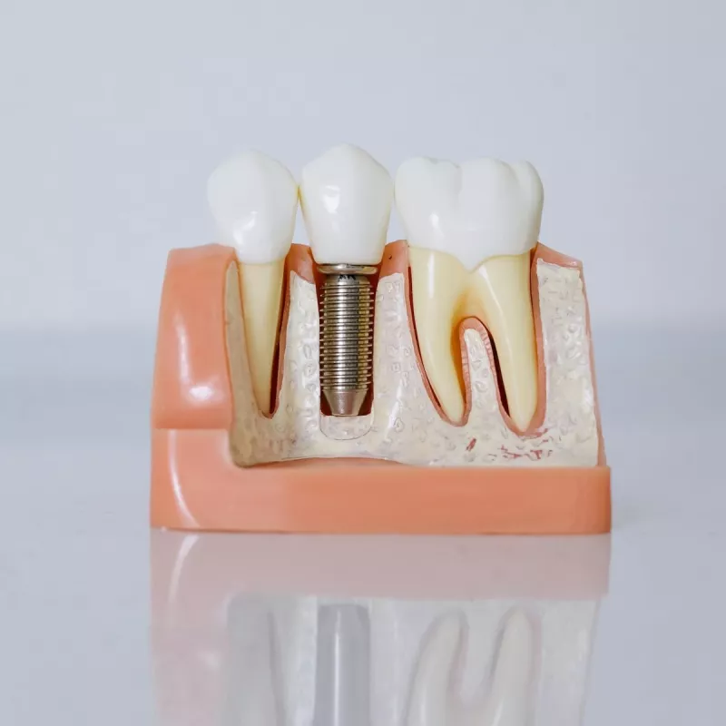 Dental Implants in Norbiton, Kingston-upon-Thames Image (Mobile)