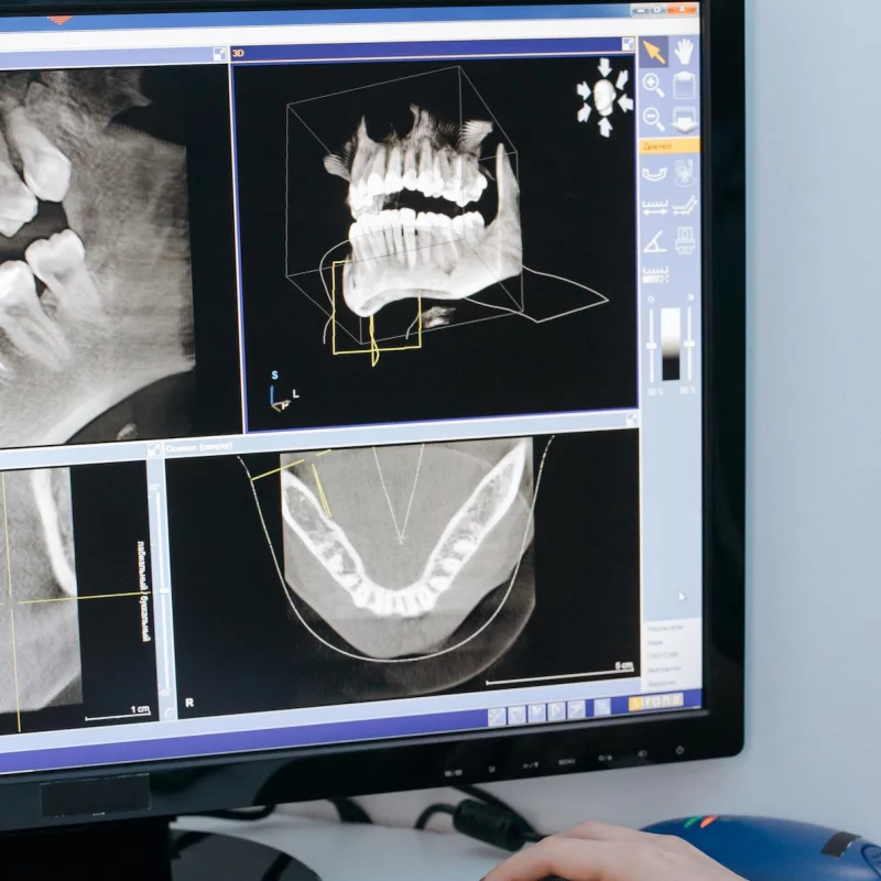 Your dental implant journey at Harmoni
