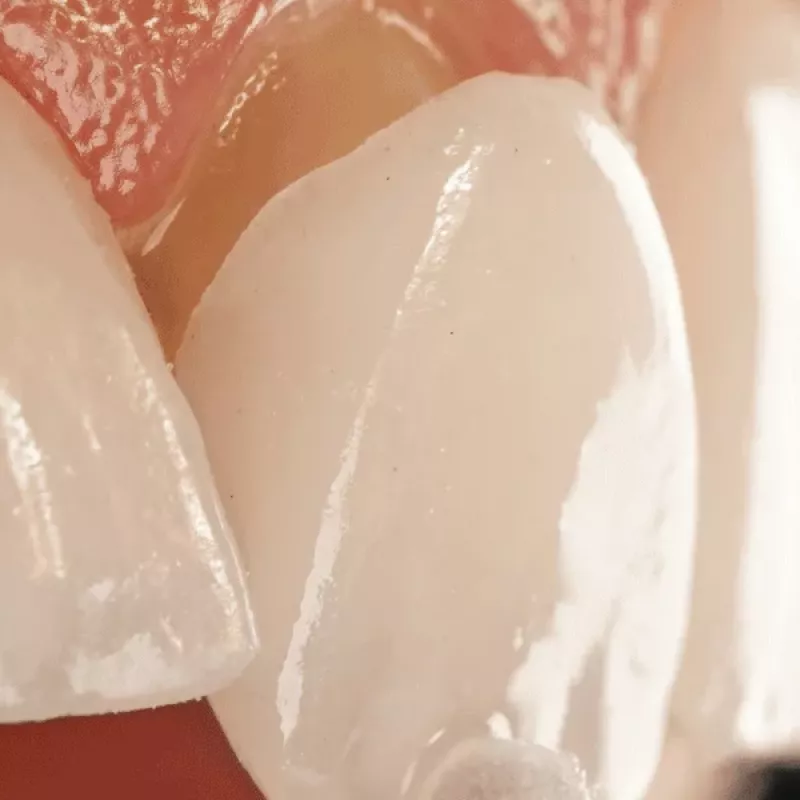 Porcelain Veneers in Norbiton, Kingston-upon-Thames Image (Mobile)