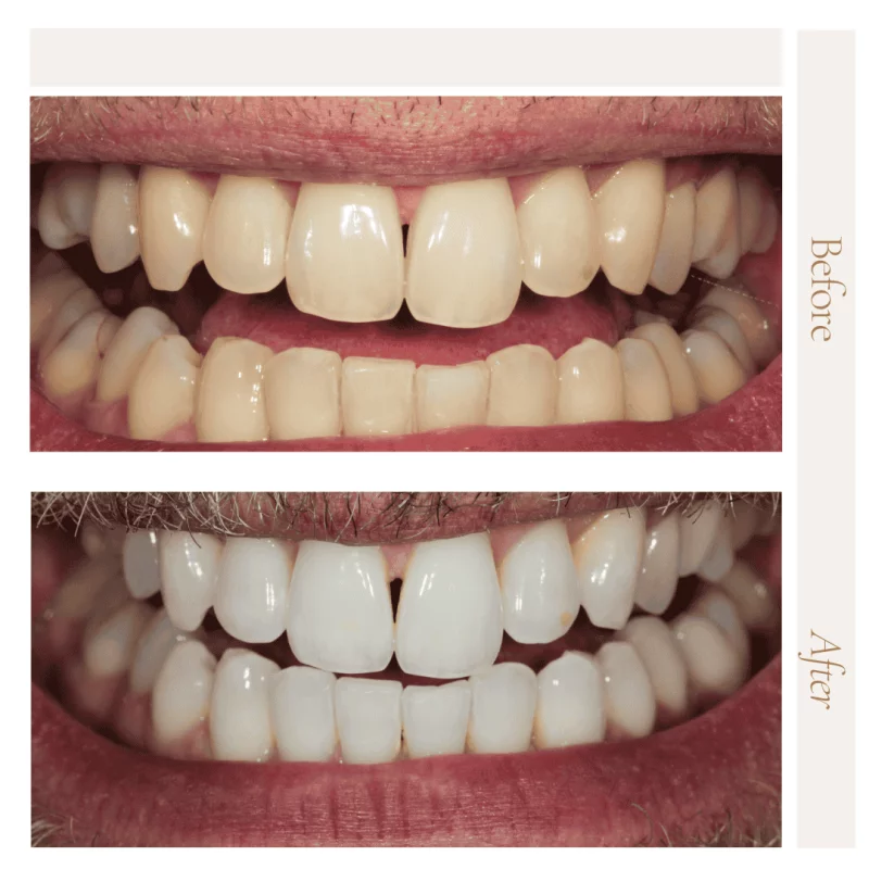 Tooth whitening Harmoni Dental Kingston
